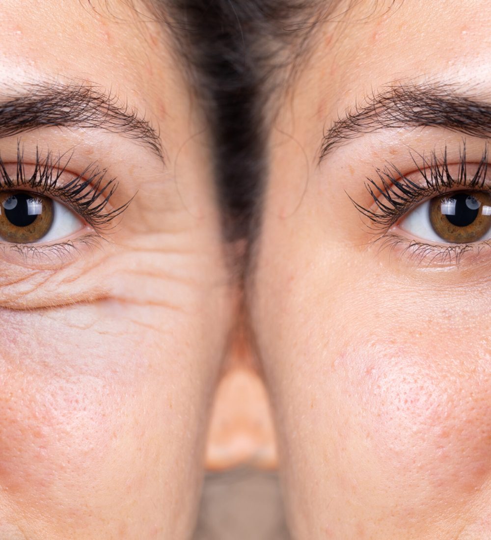 blepharoplasty-scar-management-naples-fl-01-1-scaled