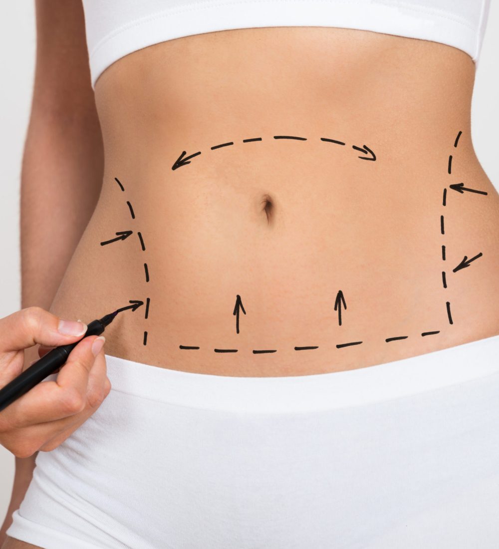 coolsculpting-vs-liposuction-vs-tummy-tuck-cover-photo-scaled-1-1.jpeg