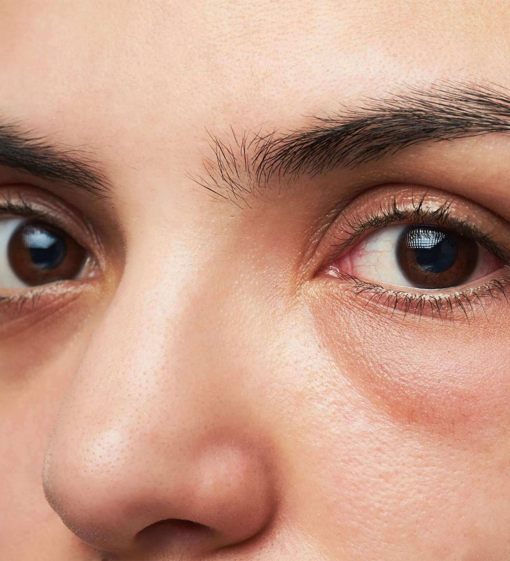 under-eye-dark-circles_122888124